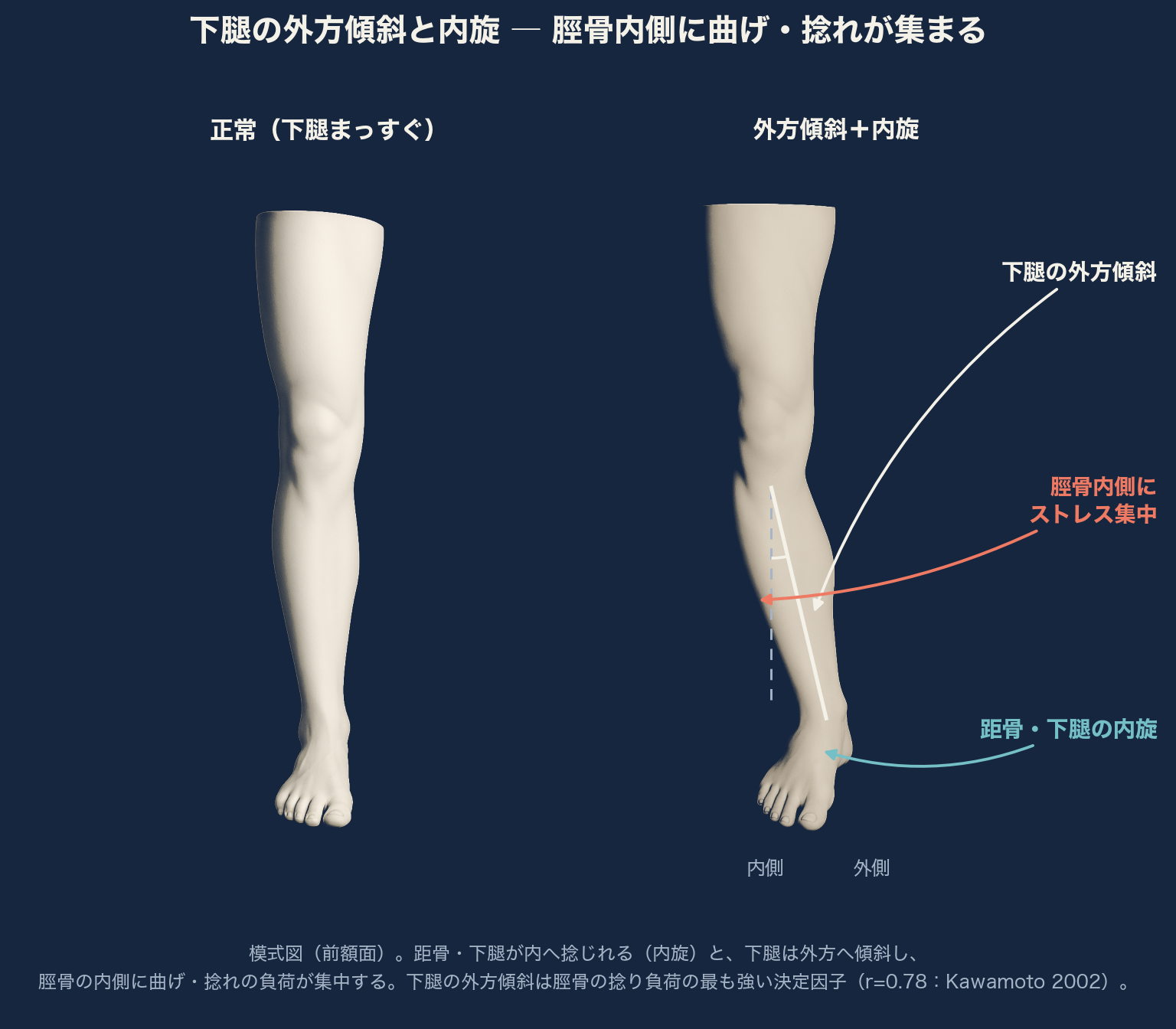 下腿が外へ傾くと、脛骨の内側に曲げ・捻れストレスが集まる（模式図）